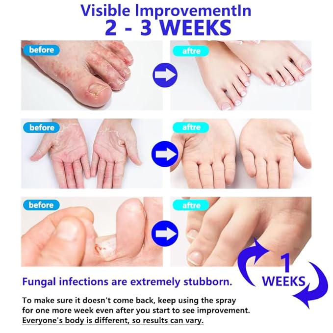 VAMY Natural Foot & Shoe Deodorizer Spray -Athletes Foot Spray, Natural Foot Care for Itching & Odor Relief, Soothing Formula with Botanical Extracts. Fragrance Free (1 PCS)