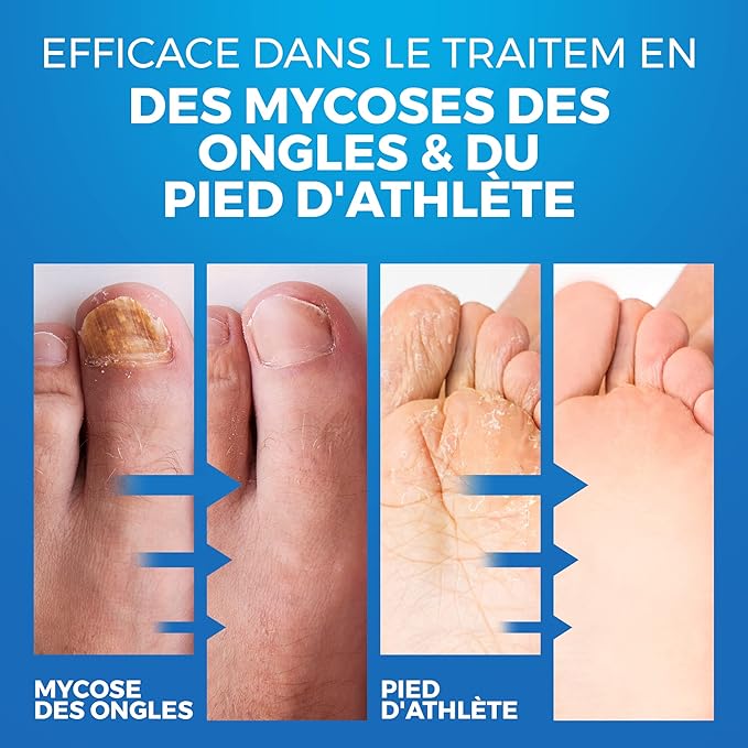 Advanced Foot & Shoe Deodorizer Spray (150ml) - Promotes Healthy Nails & Toenail Condition - Athletes Foot Shoe Spray for Fungal Treatment | Anti Toe Fungus Treatment and Foot Fungus | 150 ML